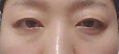 もう目の下の脂肪再配置の手術をしてから3ヶ月以上経ちましたね。