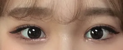 ベリーグッド美容外科で自然癒着、目頭切開を受けました！