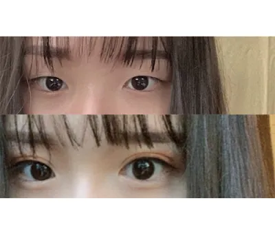 手術前は目にシワが多くて心配していましたが、本当に理想通りになりました。