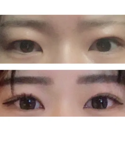 二重整形をして、今すごく気に入ってて嬉しいから投稿する。