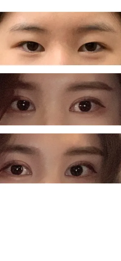 二重切開再手術、目尻切開・タレ目形成（切開デュアル切開）、切開目つき矯正レポ
