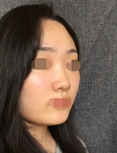 院長先生が本当に客観的に改善すべき点を教えてくださり、デザイン的な質問をした際も不可能な部分はあらかじめ伝えてくださるなど、正直にカウンセリングしてくださってさらに良かったです。