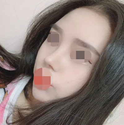 初鼻、鼻筋、鼻先、短い鼻、小鼻縮小しました。