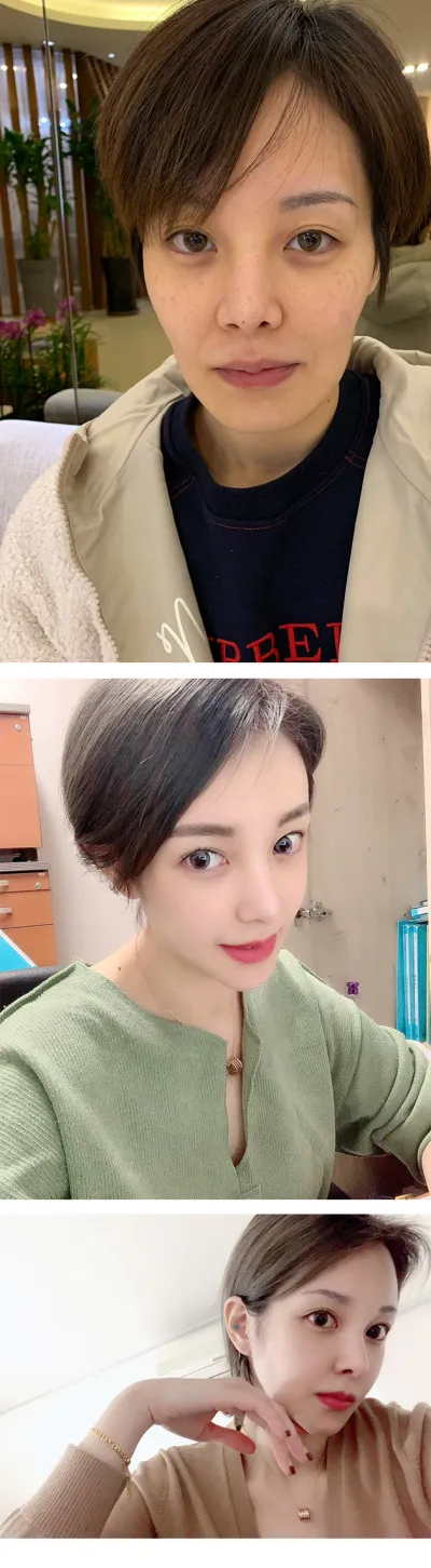 もう1年近く経つ気がします。顔の凹凸もだいぶ良くなりました（笑）フェイスラインが整ってきたので、自撮りもよく撮っています（笑）