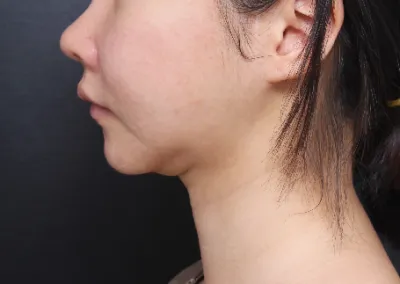 抜糸やアフターケアも一つ一つ丁寧にしてくださいました。脂肪吸引はリバウンドがないので、脂肪吸引を悩んでいる方はベリーグッドに行ってみてくださいね。