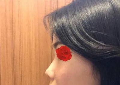 他の院長先生に手術してもらっていたら、絶対にこれほどの高さは出なかったと思うので、全く後悔していません~~！！