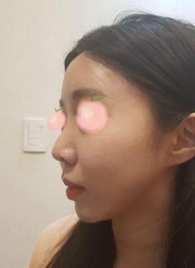 自家肋軟骨で鼻整形しました。今すごく満足していますｗｗｗｗ