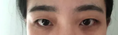 キム・ジュンヒョン院長、本当にありがとうございます！！！私は自然癒着と目頭切開をしました！