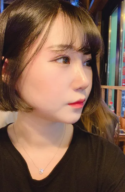 初雪、目つき矯正、目頭切開、デュアル切開、鼻筋、鼻先、鷲鼻矯正、とても満足しています。