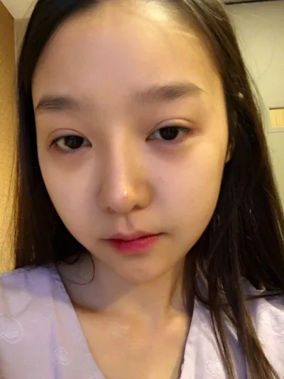 目の再手術を受け、今回は鼻の再手術を受けました。