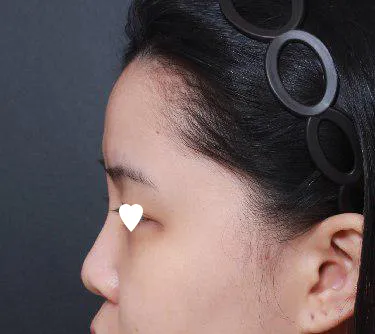 イム・ヨンミン院長に鼻の手術を受けましたぁww