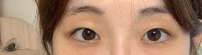 初めての目整形、自然癒着、目頭切開のレポです！
