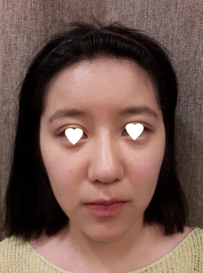 頬骨、長曲線、顎先、鼻再手術をしました。