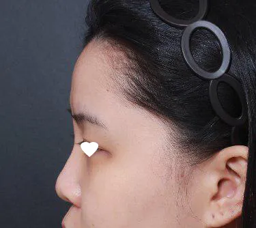 ベリーグッド美容外科でイム・ヨンミン院長に鼻の手術を受けました(笑)