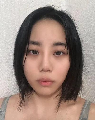 今は腫れもすっかり引いて、理想通りのラインで自然に目が大きくなったので、本当に満足していますㅠㅠ