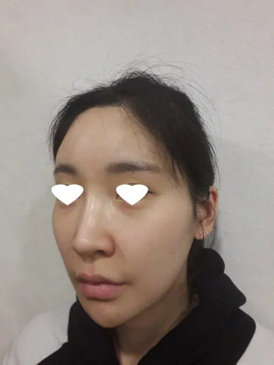 頬骨縮小術、とても自然で満足です^^