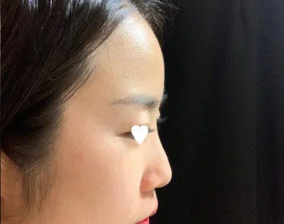 周りからもみんなラインが綺麗だって大騒ぎです！www 私が理想としていた鼻先のラインです（泣）ありがとうございます。