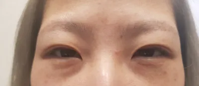 キム・ジュンヒョン院長に切開で二重再手術を受けました〜