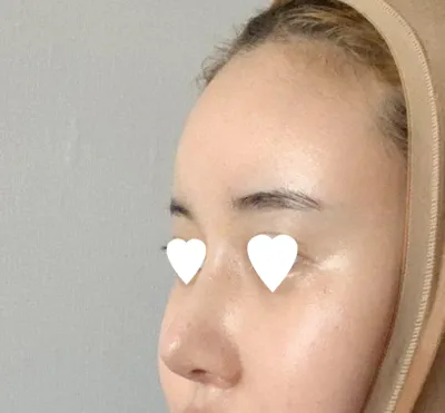 院長先生はイム・ヨンミン院長先生に鼻の再手術を受けました！！！