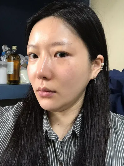 施術から3週間ほど経ったレビューです〜