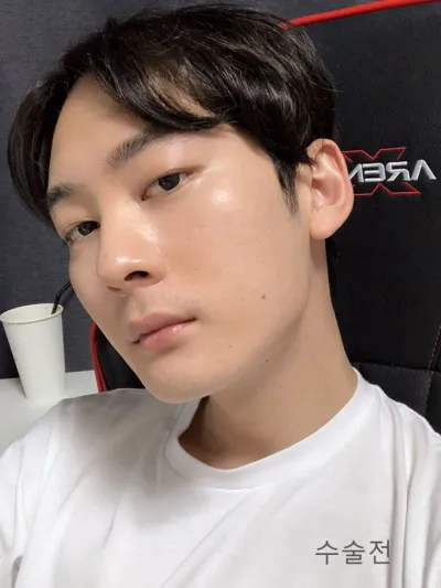 こんにちは！手術から2ヶ月の経過レポを残します！！