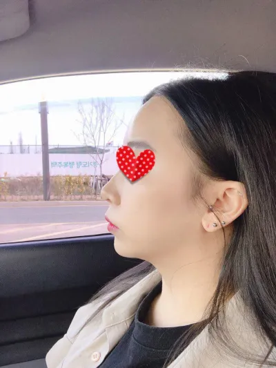 ベリーグッド美容外科で4月9日に顔全体の脂肪移植を受けました〜