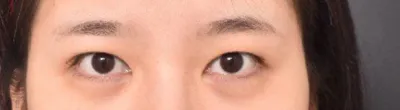 目の再手術4ヶ月目です。今はとても満足しています。♥