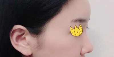 鼻の再手術3ヶ月目です^^