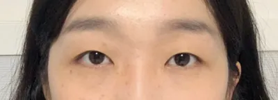 二重整形のレポアップします！！笑