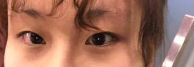 二重整形の神クリニック見つけました！！