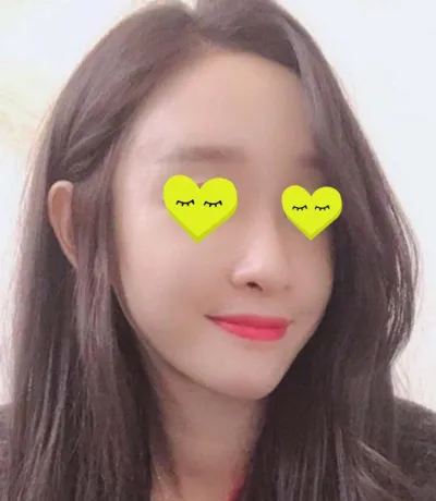 キム・ジュンヒョン院長先生にフルフェイス脂肪移植を受けました！