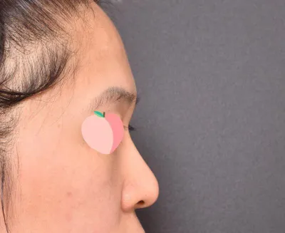 ベリーグッド美容外科のイム・ヨンミン院長に鼻整形を受けました。