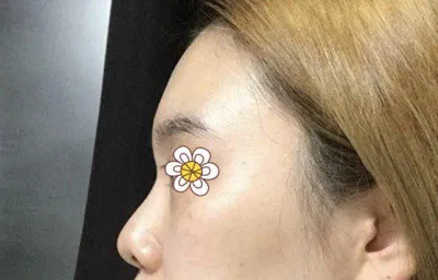 鼻の再手術、とても綺麗です!!!!