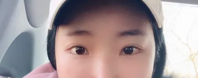 タレ目再手術しましたww