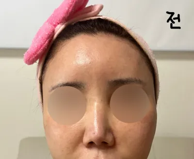 短い鼻再手術レポ