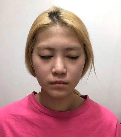 鼻 | 脂肪 | その他 手術体験談