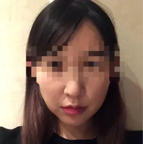 リフトアップ手術の体験談