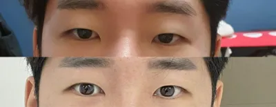 目の手術体験談