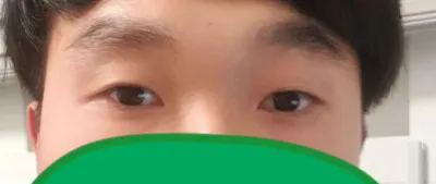 目の手術体験談