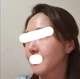 リフティング | 脂肪手術レポ