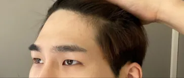 目 | リフト手術体験談