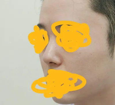 鼻の再手術体験談