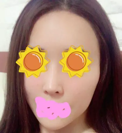 輪郭整形 | その他手術体験談