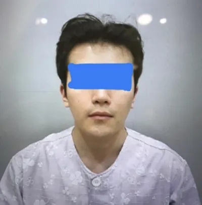 輪郭整形の手術体験談