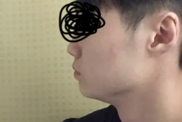 輪郭整形 | その他手術体験談