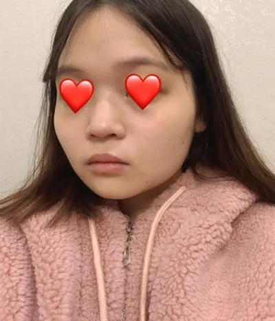 鼻 | 輪郭手術レポ