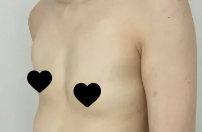 豊胸手術のレポです。