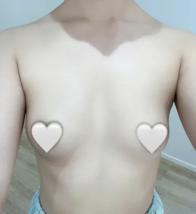 メンエク+副乳除去) 1ヶ月大満足レポ