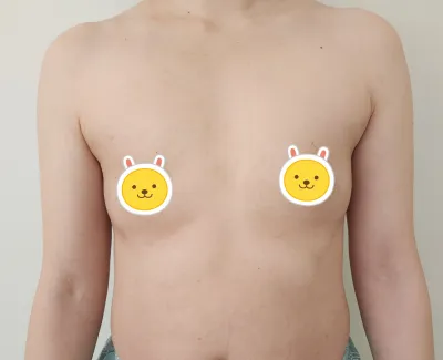 [再手術] メロン胸 1週間目！