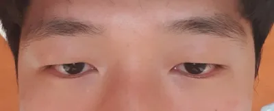 切開式目つき矯正